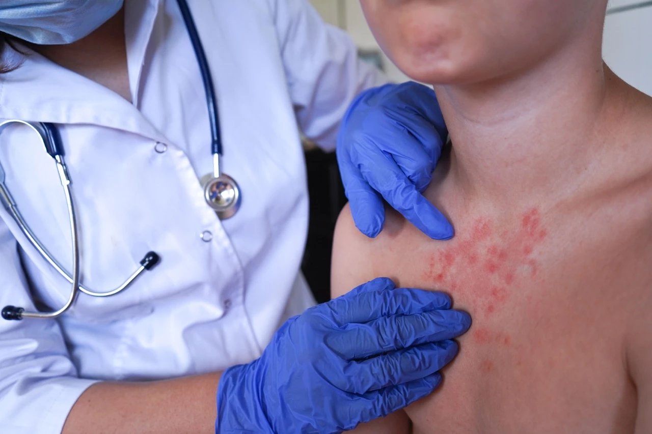 Lichen planus: achter een chronisch letsel schuilt een sterk uiteenlopend kankerrisico