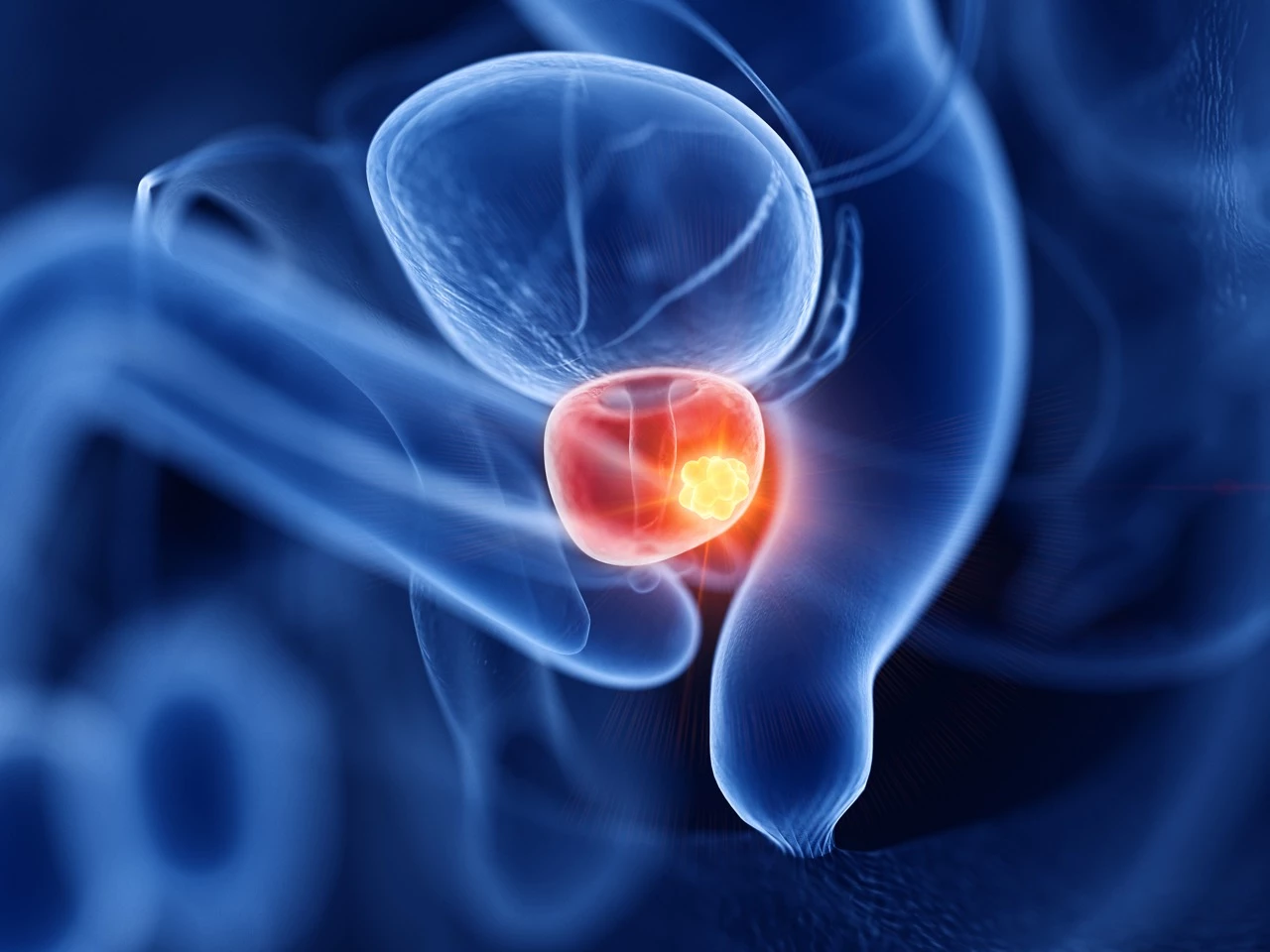 Cancer de la prostate métastatique hormonosensible : talazoparib plus enzalutamide retarde nettement la progression