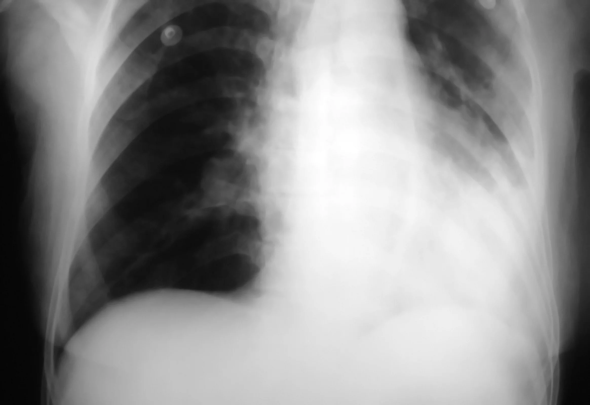 Pneumonie sévère : trois profils biologiques derrière un même tableau clinique