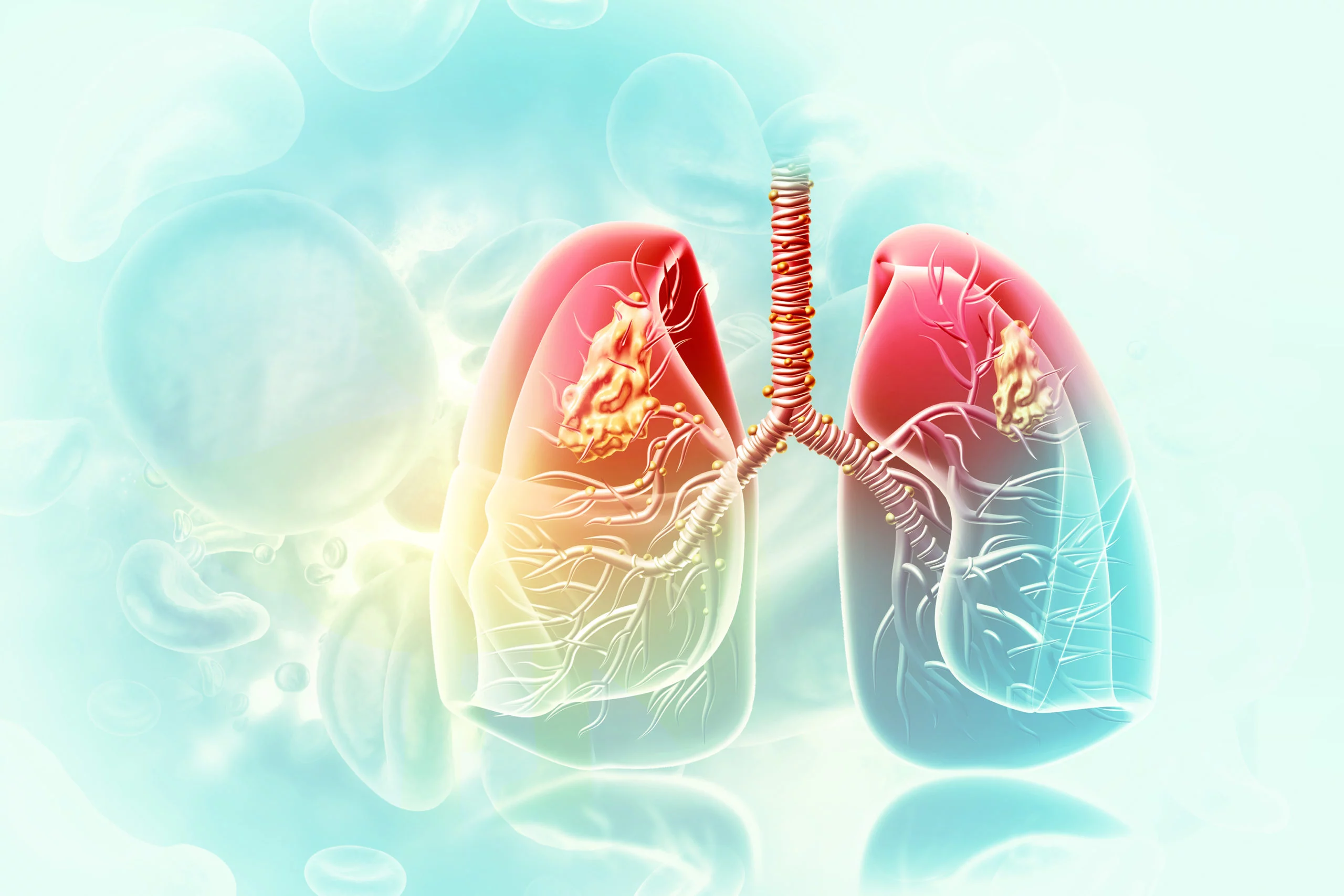 Cancer du poumon : l’IA fait mieux que le seul PD-L1 pour prédire l’immunothérapie
