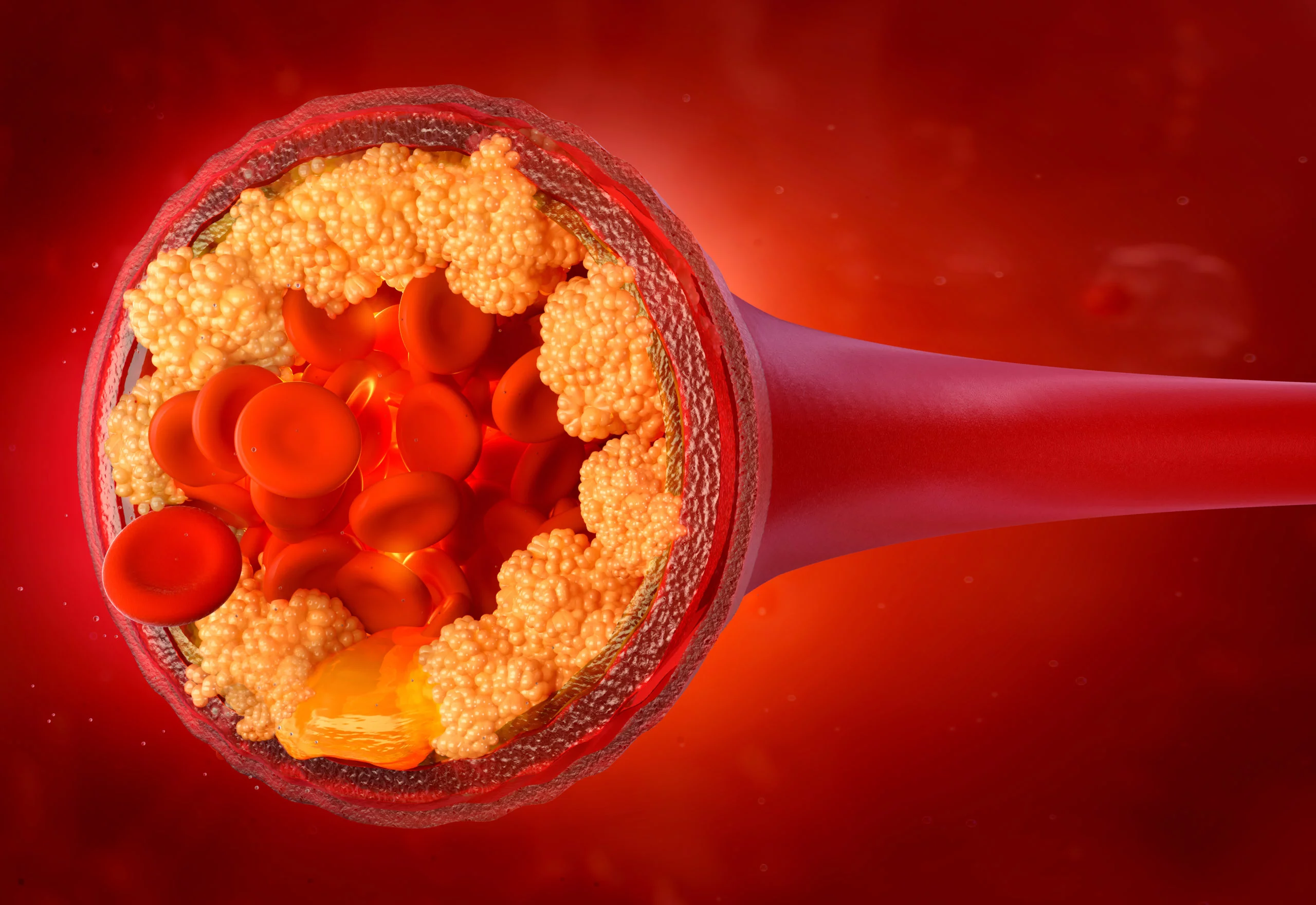 VERVE-102 : une seule perfusion pour réduire durablement le LDL-cholestérol ?
