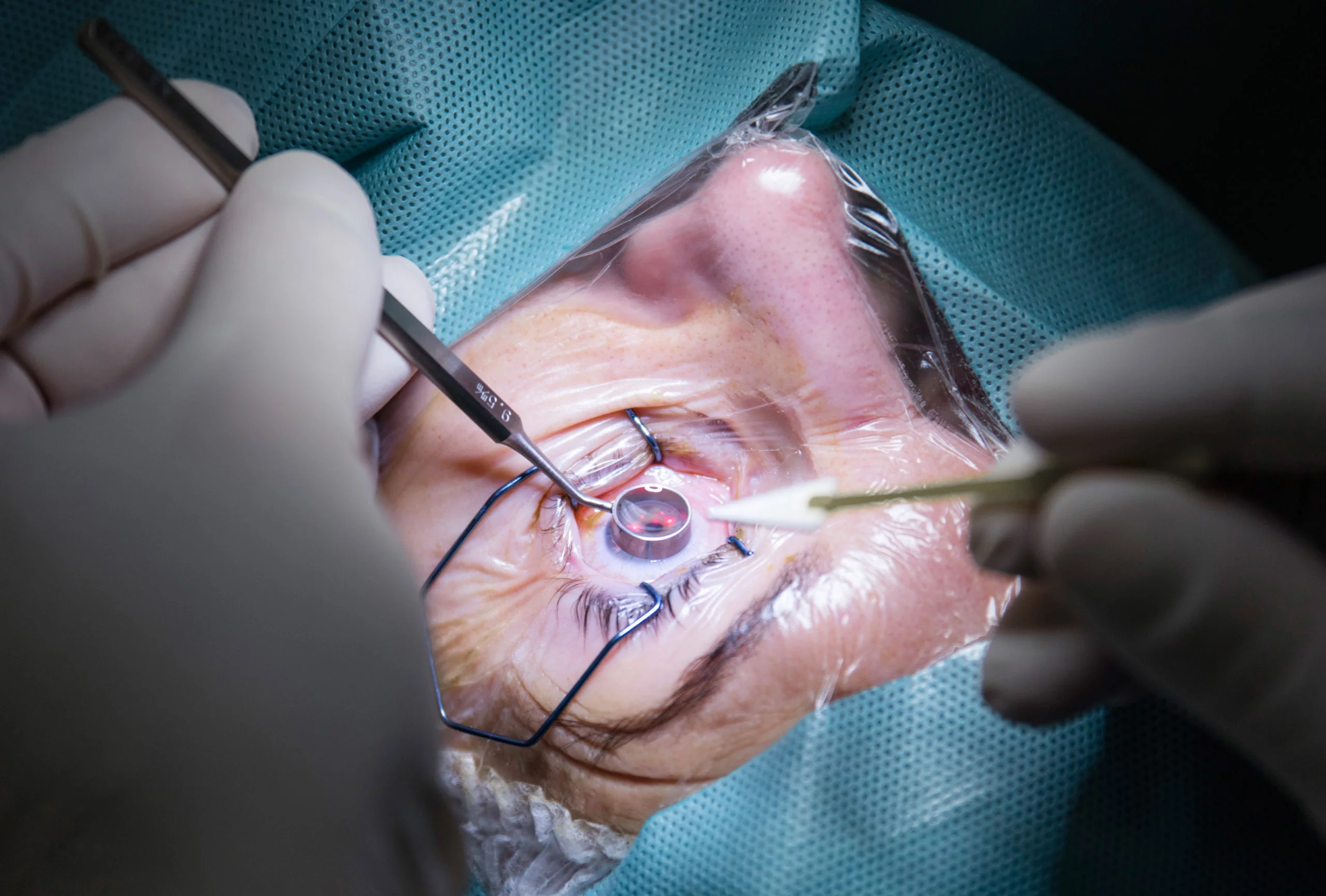 Chirurgie réfractive : qui risque des symptômes prolongés ?