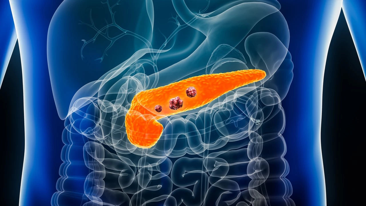 Cancer du pancréas : une IA repère des anomalies tissulaires précliniques invisibles au scanner standard