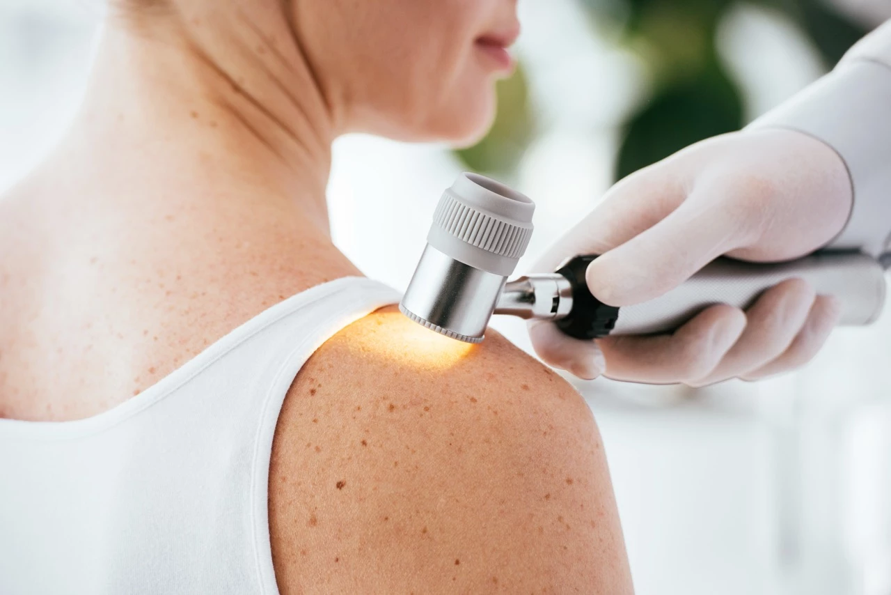 Mélanome : un « tatouage intelligent » pour détecter des lésions encore invisibles