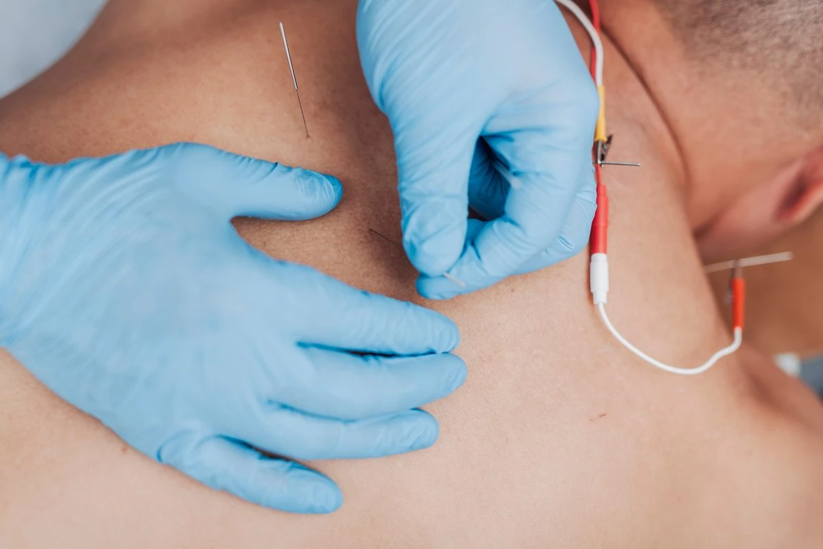 Delirium postopératoire : un signal intéressant pour l’électroacupuncture